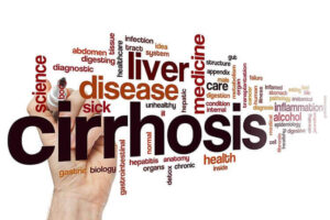 Alcoholic Liver Cirrhosis: Strictly An Alcohol-Driven Health Complication